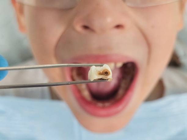 Best Emergency Treatment for Dental Infections or Abscesses in Circle Pines, MN